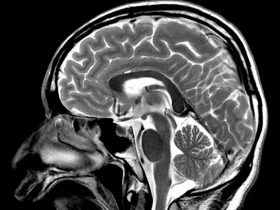 consulenze neuroradiologiche - risonanza magnetica e TC - Dr. Nicola Morelli